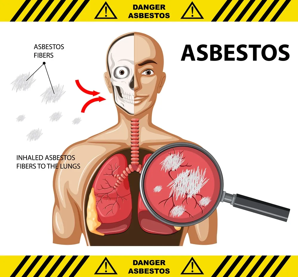 A human body diagram with asbestos in the lungs